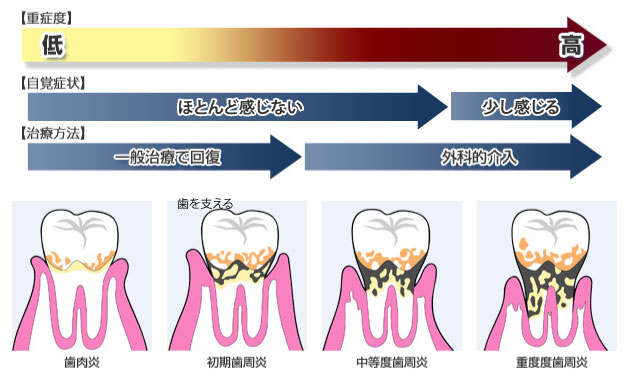 歯周病について